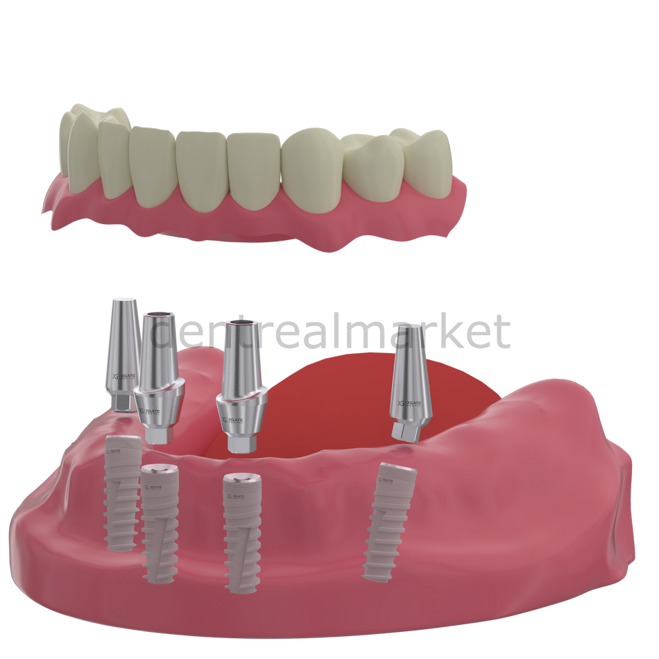 DentrealStore - X-Gate Dental X3 Internal Hex Implant Body - Diameter 3.3 mm - Single Platform Implant