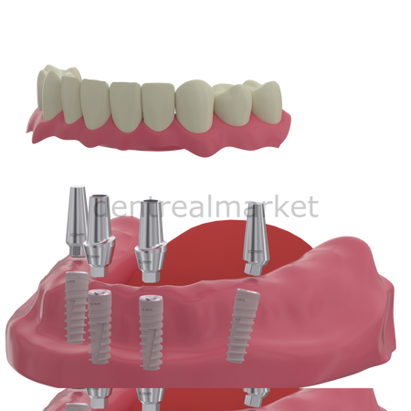 DentrealStore - X-Gate Dental X3 Internal Hex Implant Body - Diameter 4.2 mm - Single Platform Implant