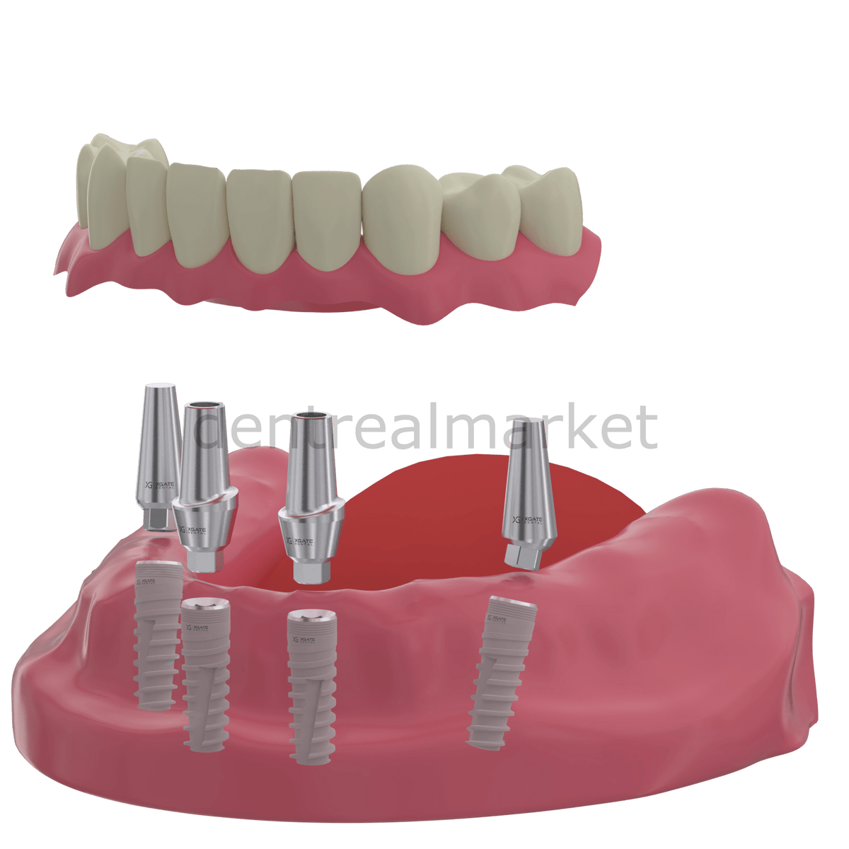 X - Gate Dental - X3 Internal Hex Implant Body - Diameter 4.2 mm - Single Platform Implant